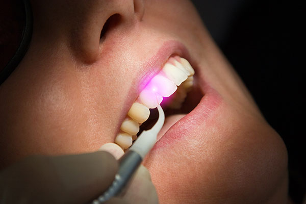 The image shows a close-up view of a person receiving dental treatment, with a focus on their mouth and teeth being worked on by a dental professional using a light to examine them.