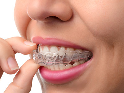 The image shows a person wearing clear braces with pink elastics, holding their teeth together, and appears to be examining them closely.
