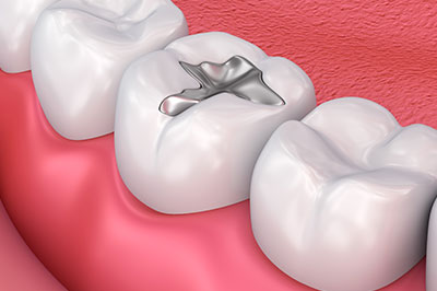 The image shows a 3D rendering of a human mouth with teeth, featuring an artificial tooth with a visible metal screw, set against a red background that simulates gum tissue.