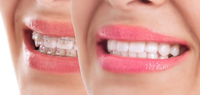 The image shows a woman with a radiant smile, displaying her teeth and lips, which are enhanced by lipstick.