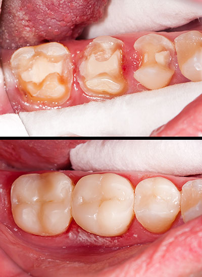 The image displays a close-up view of a person s mouth with teeth showing signs of decay and gum disease, before and after dental treatment, highlighting the cleaning process and the resultant improvement.