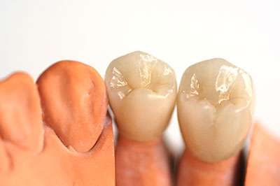 The image displays a close-up view of two artificial teeth with visible dental implants, placed next to each other against a white background.