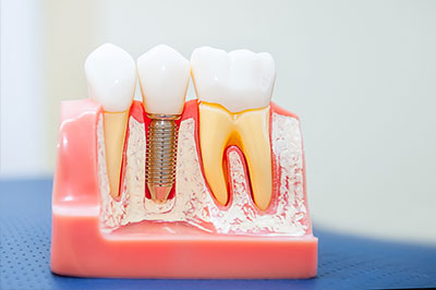 The image shows a dental model with artificial teeth, including a tooth with an exposed root, a missing tooth with a hole for implantation, and a tooth with an implant screwed into it.