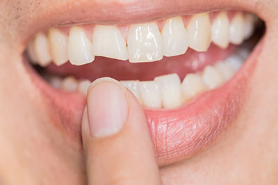 The image shows a close-up view of a person s mouth with teeth, holding their finger near their lip, which appears to be a toothpick.