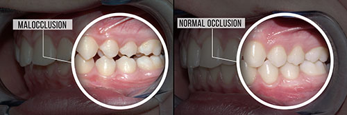 The image shows a person s teeth with text indicating  Malocclusion  and an arrow pointing to the lower front teeth, which are misaligned.