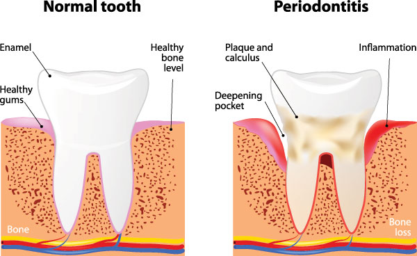 The image shows two stages of gum disease progression labeled  Normal tooth  and  Periodontitis,  with accompanying illustrations of a healthy gingiva and an inflamed, diseased gingiva, respectively.