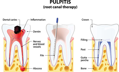 The image shows a diagrammatic illustration of a tooth with a pulpit labeled, depicting the internal structure of the tooth, including the pulp chamber and root canal therapy process with annotations and labels explaining the different parts.
