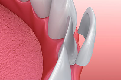 The image displays a close-up view of a dental implant with a pink gum line, showing its metallic structure and how it integrates into the mouth.