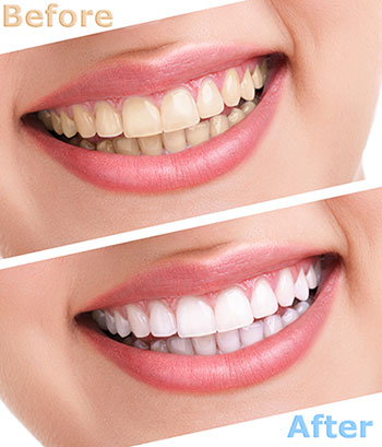 The image displays a before-and-after comparison of teeth whitening, showing a person with yellowed teeth on the left transitioning to a bright white smile on the right after the treatment.