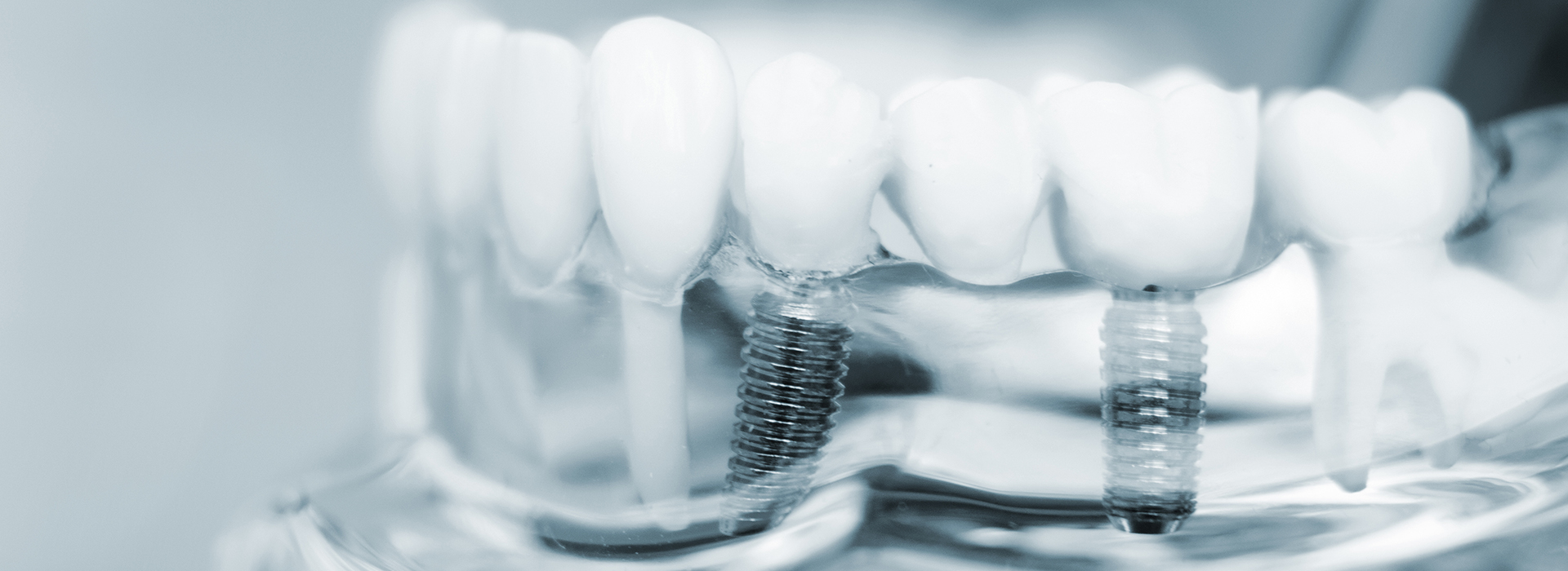 A close-up photograph of a dental implant screwed into a patient s mouth, with a focus on the screw and surrounding teeth.