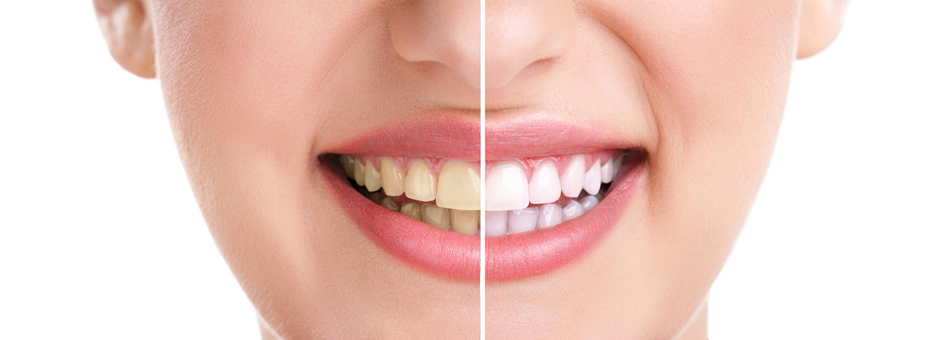 The image shows a person with a wide smile revealing their teeth and gums, with a close-up view focusing on the upper part of their face, including their nose and cheek.