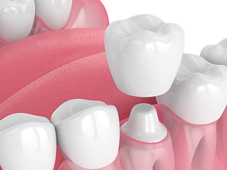 The image displays a close-up view of several artificial teeth with a pink gum background, showcasing their design and coloration.