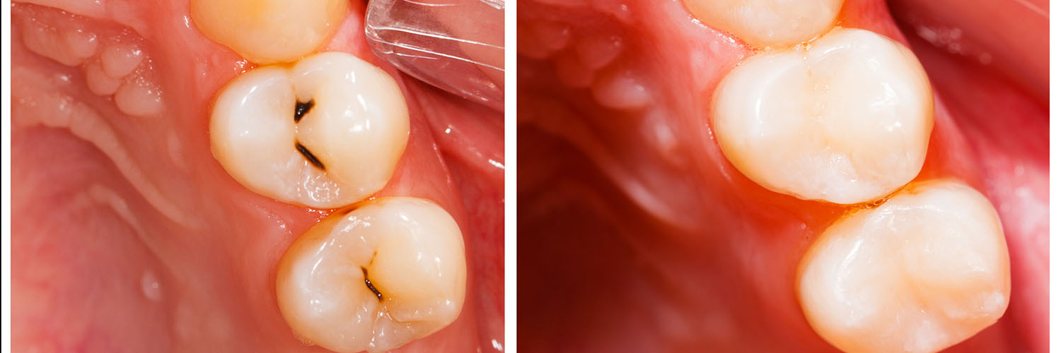 The image shows a close-up view of a mouth with teeth, where two front teeth are missing, revealing the underlying gum tissue and bone structure.
