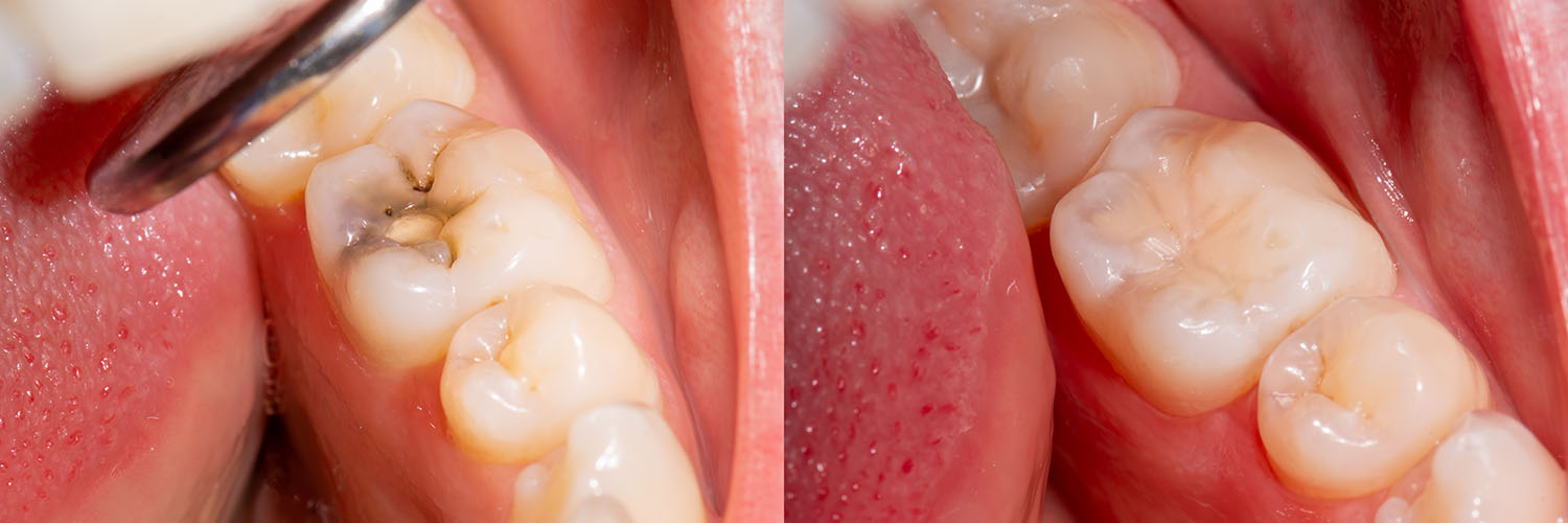 The image shows a close-up view of an open mouth with several teeth, some of which have visible cavities and stains, and one tooth being removed by a dental drill.